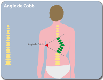 Angle de Cobb Angle de Cobb