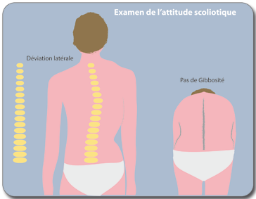 Examen de l'attitude scoliotique Attitude scoliotique