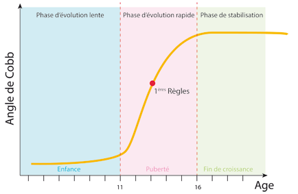 Courbe d'une scoliose évolutive