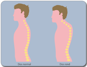 Cyphose ou dos rond