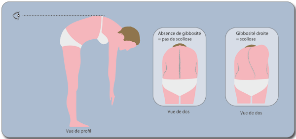 Depistage de la scoliose