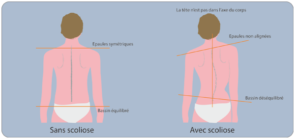 Depistage de la scoliose