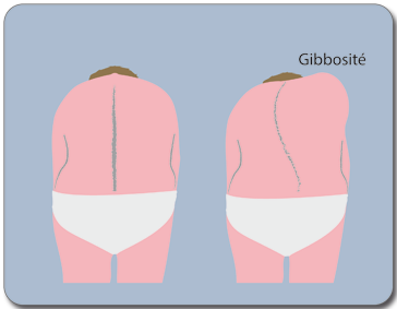 Gibbosité