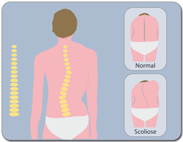 Scoliose